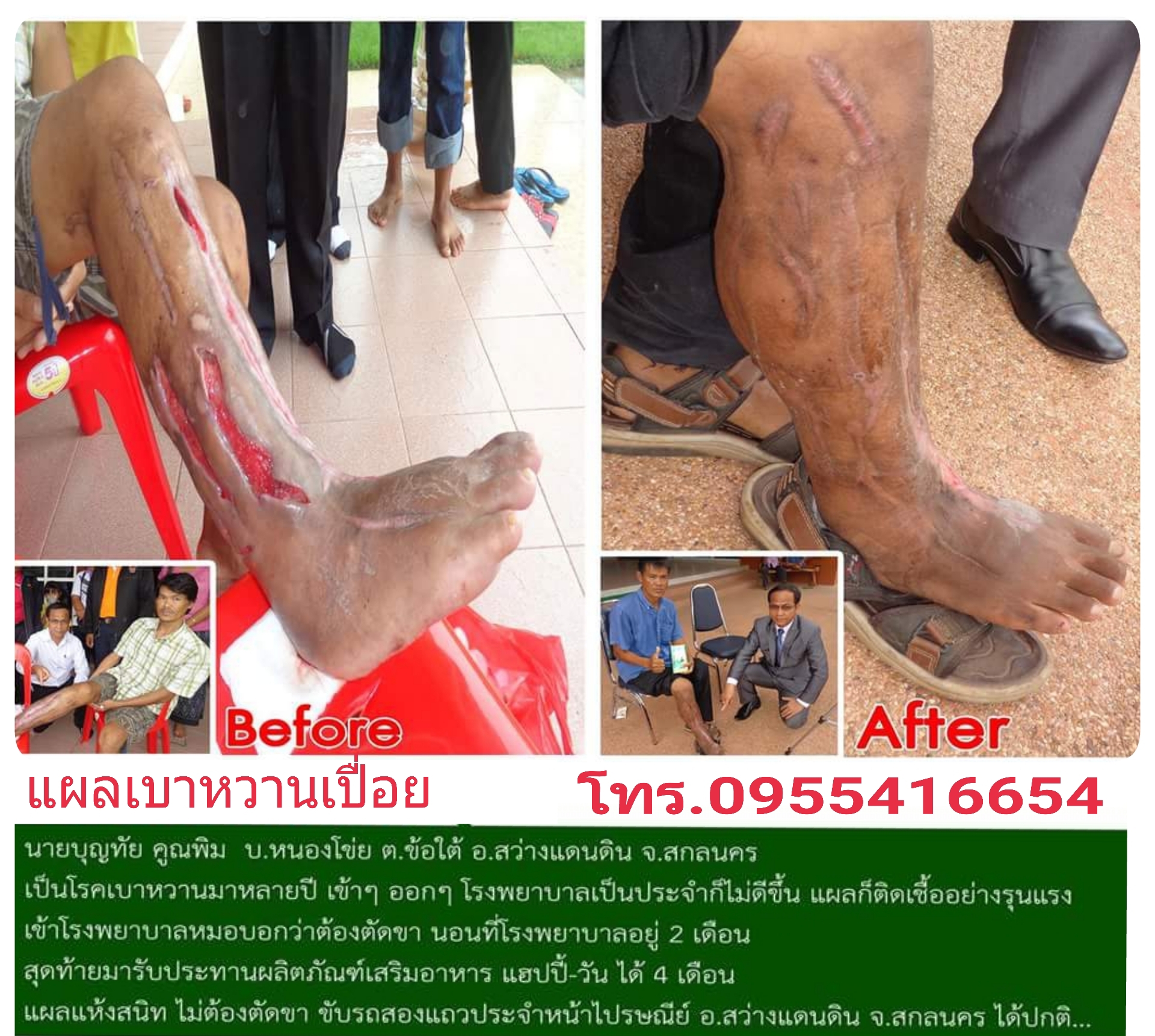 แผลเบาหวานแฮปปี้วัน เบาหวานเปื่อยทานแฮปปี้วัน