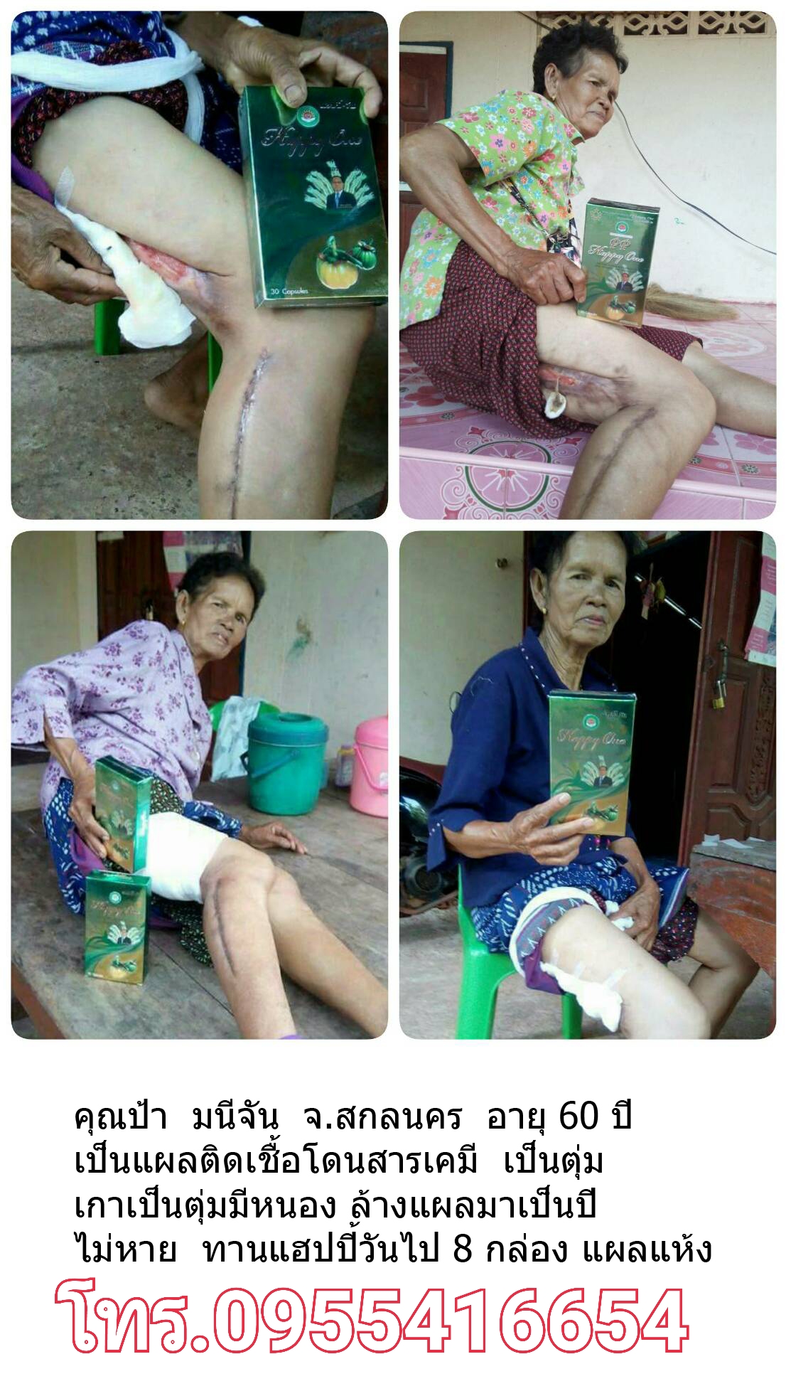 รักษาแผลติดเชื้อ แผลติดเชื้อกินแฮปปี้วัน