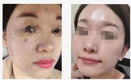เครื่องพ่นน้ำแบบไม่รุกรานโมเลกุลขนาดเล็กสำหรับใบหน้า BBface ออกซิเจนฉีดให้ความชุ่มชื้นแก่ผิวหน้าผงแห้งแช่แข็งแนะนำผลิตภัณฑ์เครื่องมือความงามออกซิเจนน้ำ