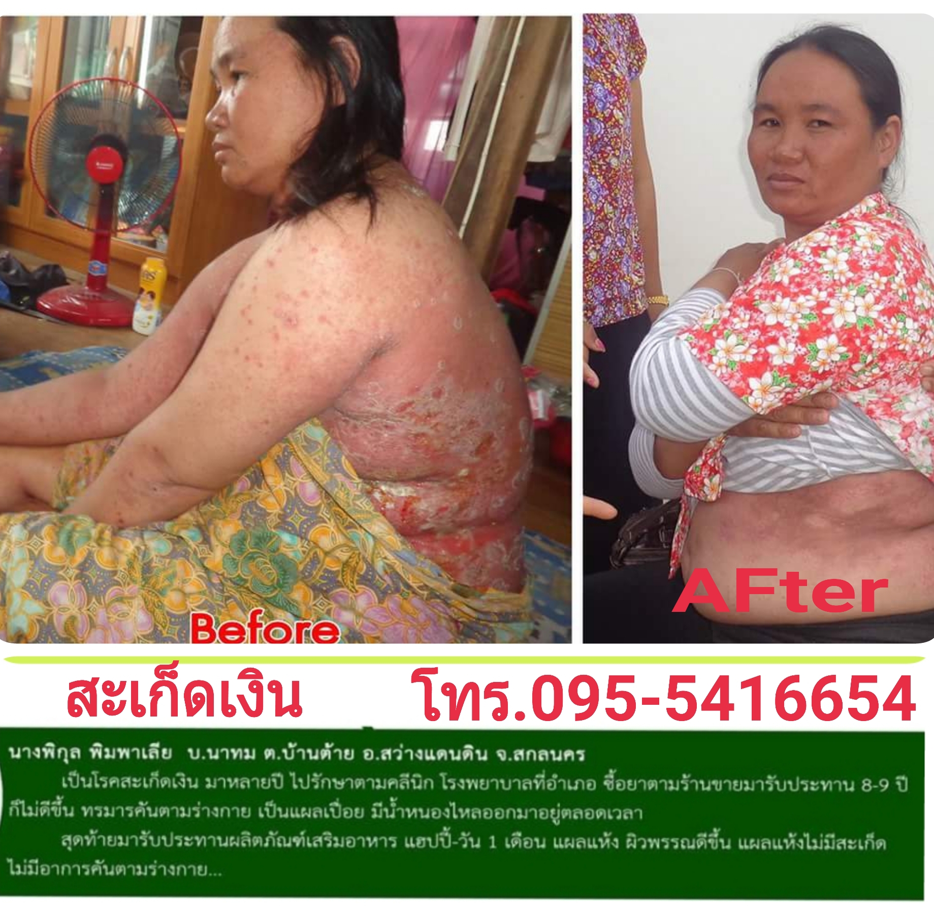 รักษาสะเก็ดเงิน สะเก็ดเงินกินแฮปปี้วัน